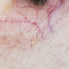 Telangiectasia or broken capillaries treatment
