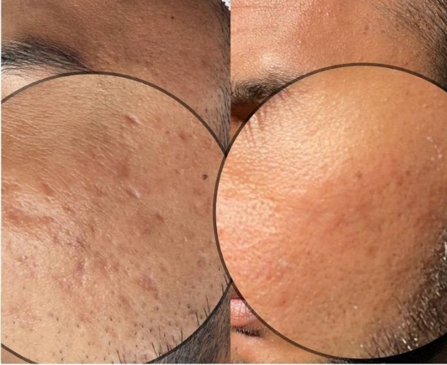 Before and after example showing acne-scar improvement