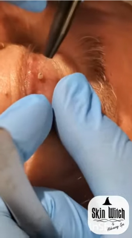 Eye skintag and keratoses treatment hideaway spa