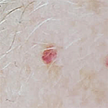 cherry angioma treatment