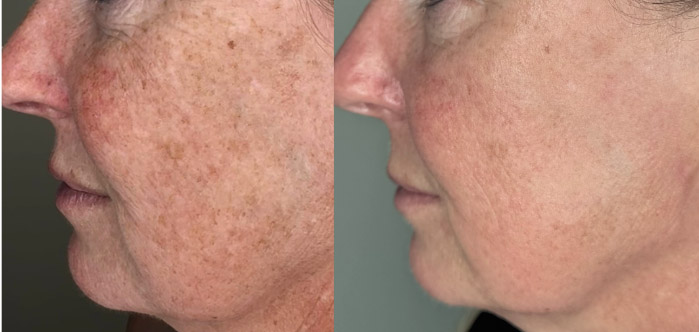 Skin showing evening of tone after microneedling treatment