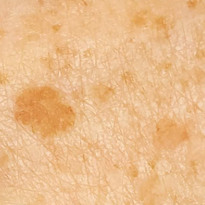 Lentigines or hyperpigmentation treatment