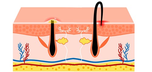 Diagram showing ingrown hair within the skin layer