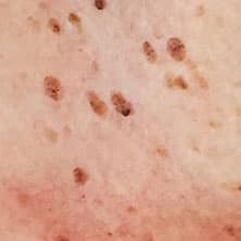Keratosis treatment with thermolysis in Windsor