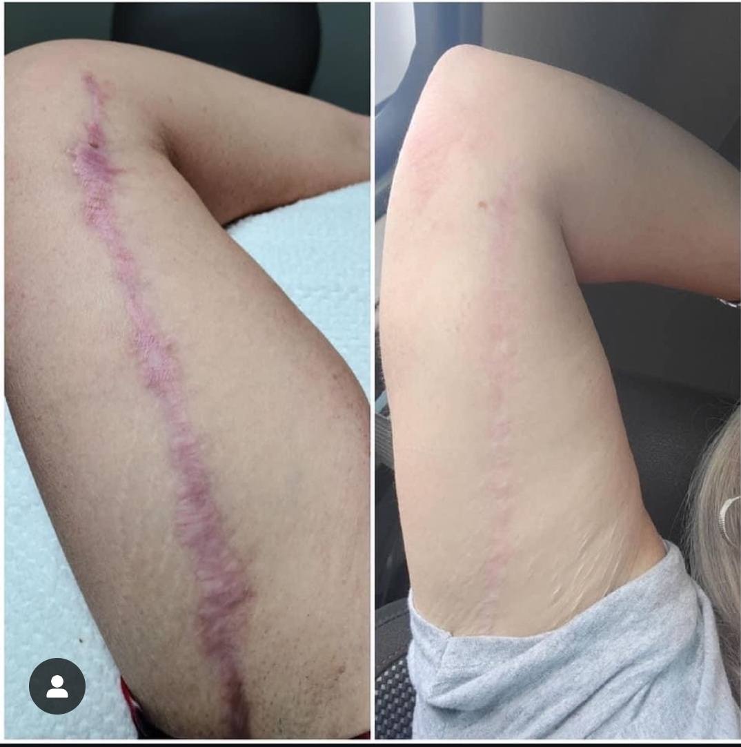 Before and after showing surgical scar improvement