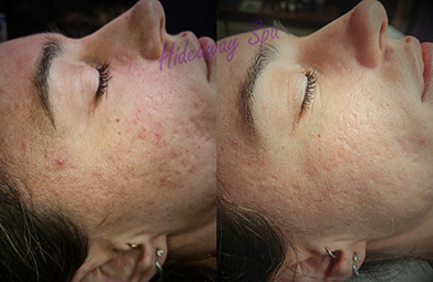 Before and after microchanneling microneedling: two treatments for acne