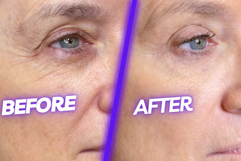 Before and after image of procell microchanneling improving facial lines and eye lift