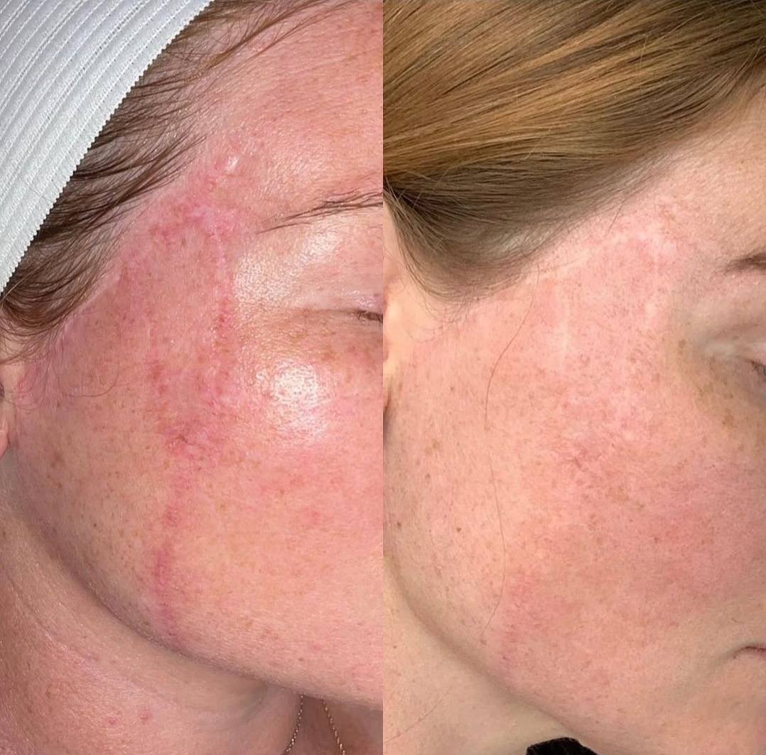 Before and after microchanneling: scar improvement