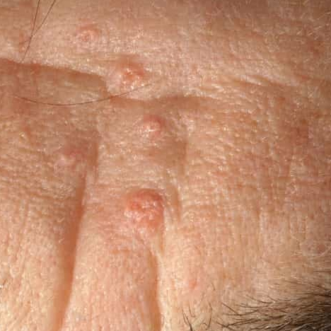 sebaceous hyperplasia treatment