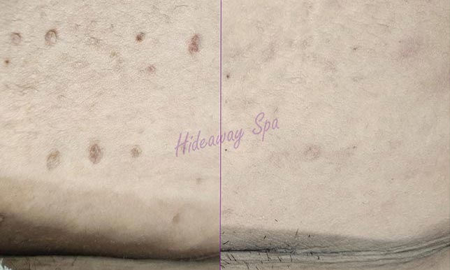 Underarm cluster of skin tags before and after thermolysis treatment