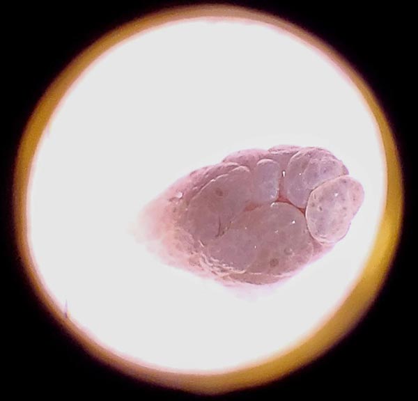 skintag seen through a profressional dermlite at Hideaway Spa