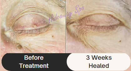Skin tag and keratosis removed from eyelid