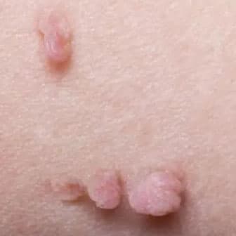 Skin tag treatment with thermolysis in Windsor