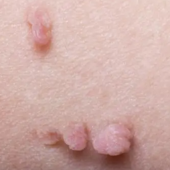 Skin tag treatment