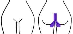 Diagram showing hair removal only from the back (thong area), excluding the cheeks