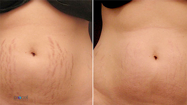 Before and after microchanneling: skin tightening improvement